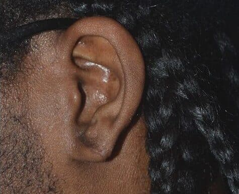 torn earlobe repair after