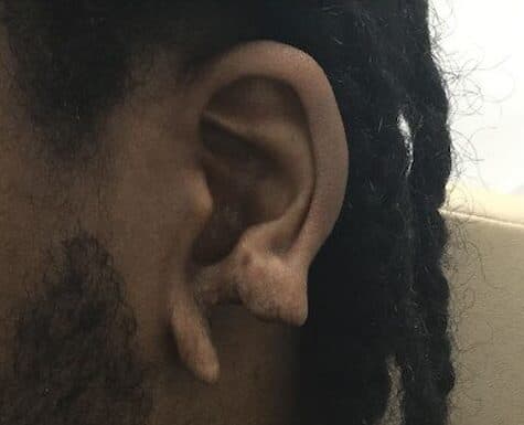 torn earlobe repair before