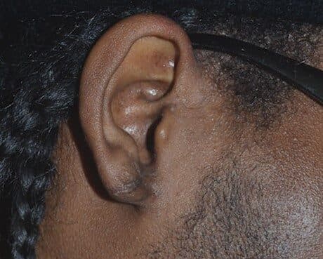 torn earlobe repair after