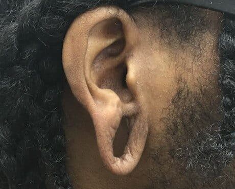 torn earlobe repair before