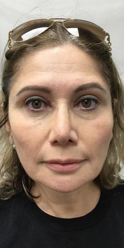 facelift after