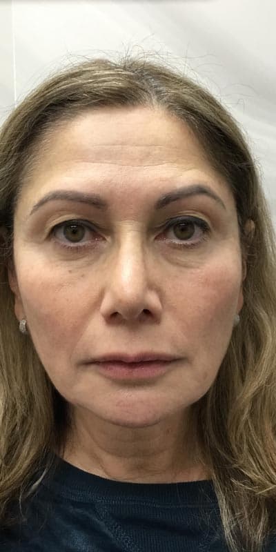 facelift before