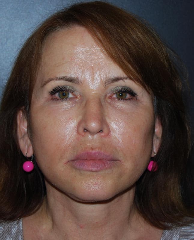 facelift after