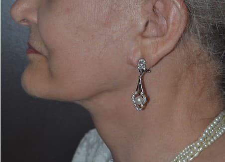 face lift after