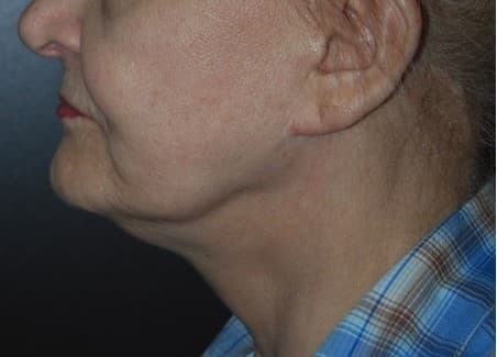 face lift before