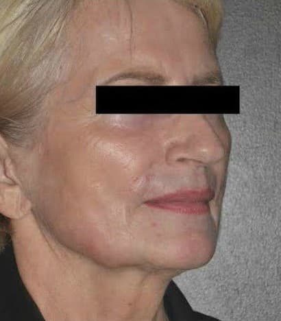 fat transfer after