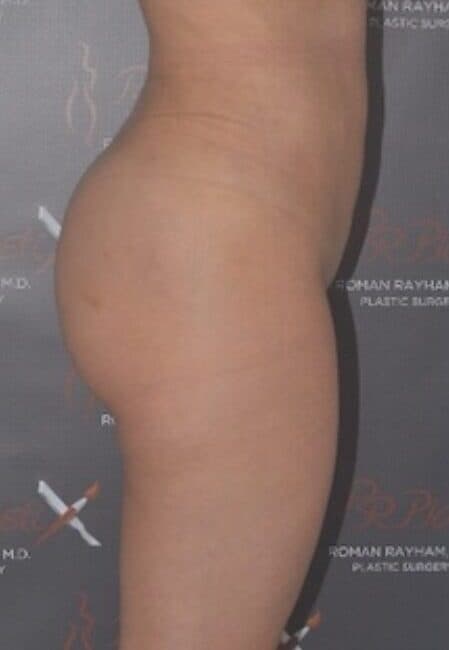 fat transfer after