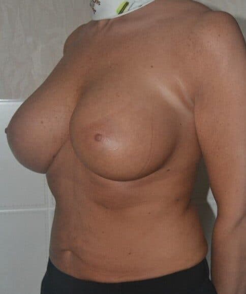 fat transfer after