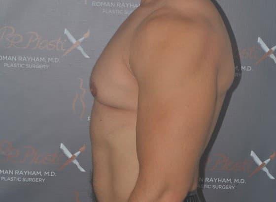 gynecomastia before