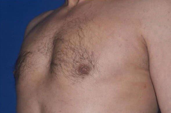 gynecomastia after