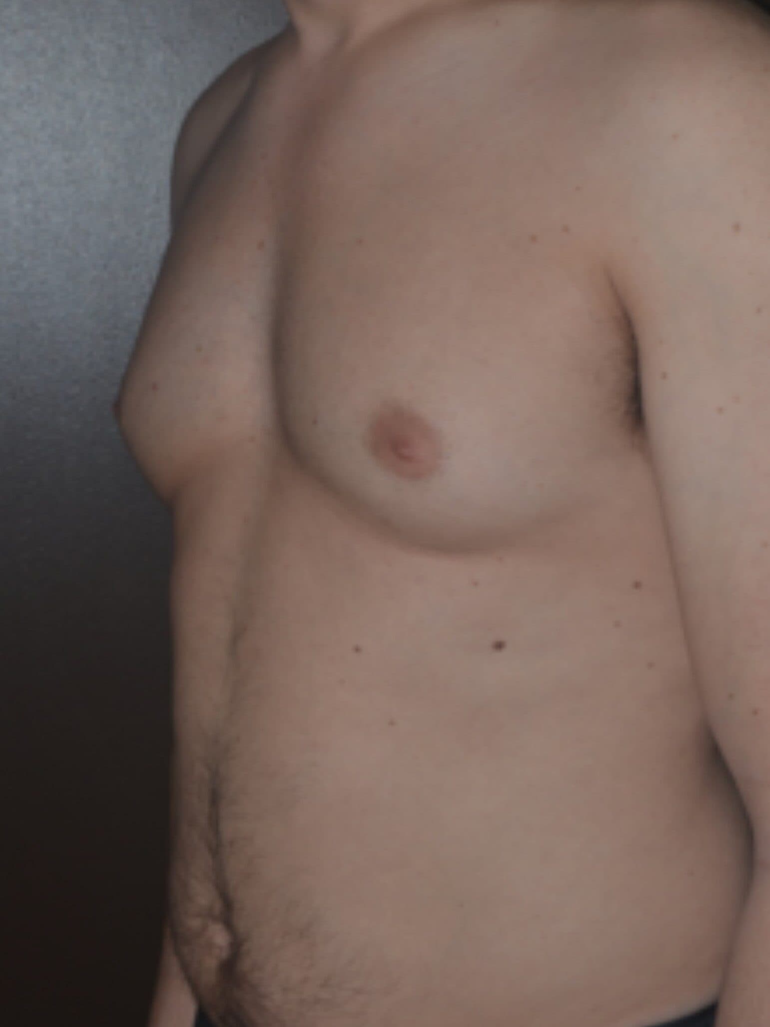 gynecomastia before