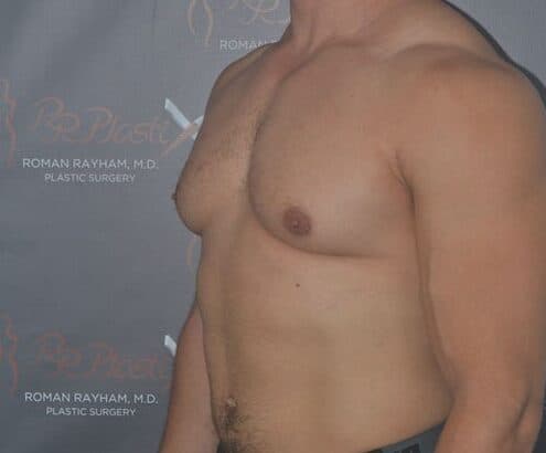 gynecomastia before