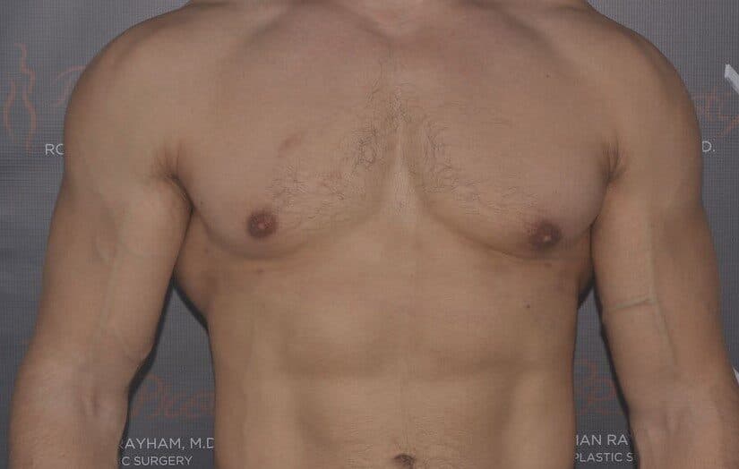 gynecomastia after