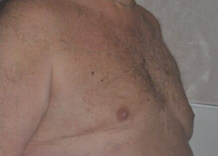 gynecomastia after