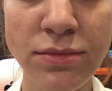 halo pro before