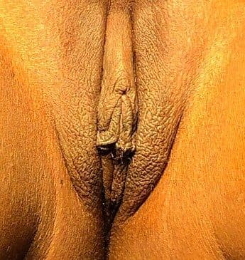 labiaplasty