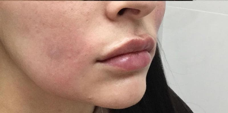 lip filler after