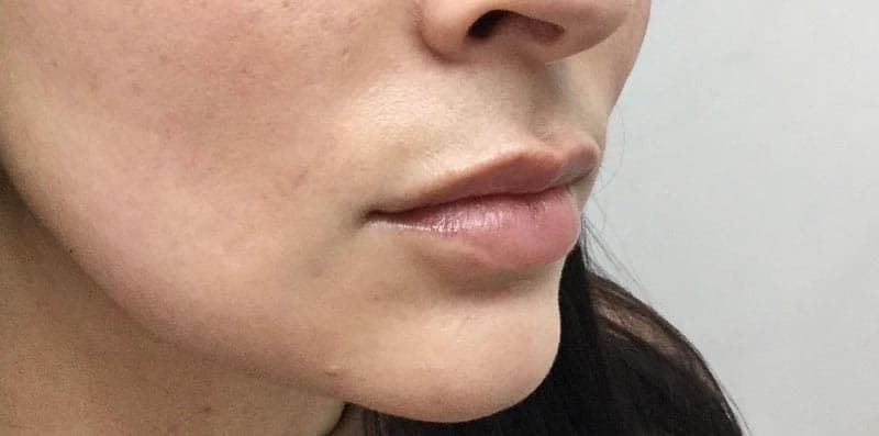 lip filler before