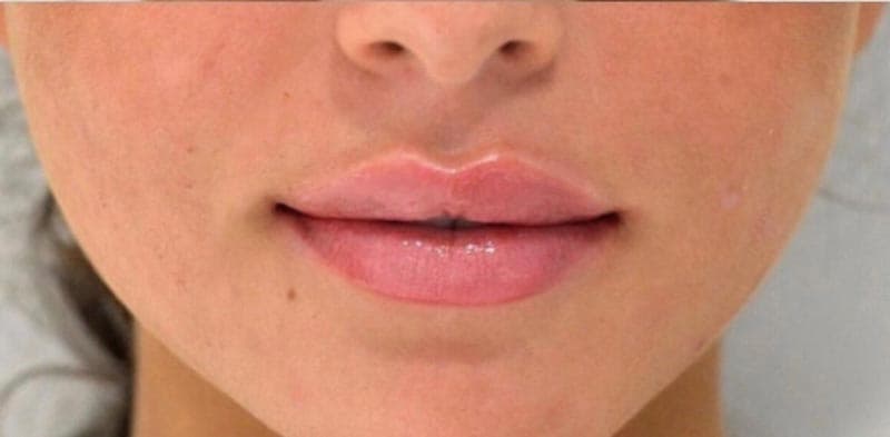 lip filler after