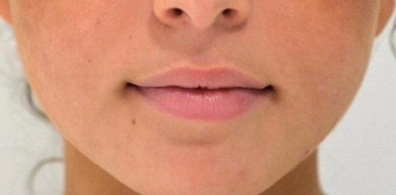 lip filler before