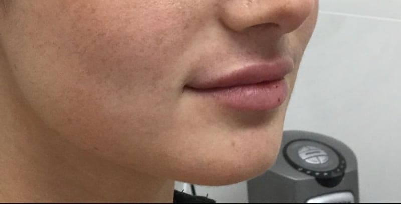 lip filler after