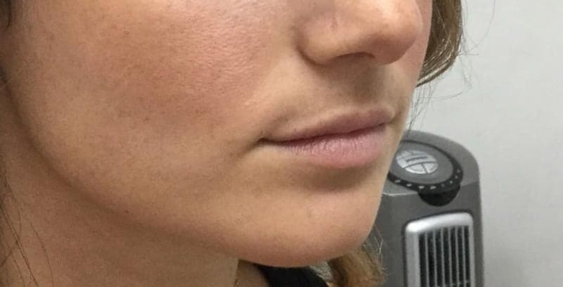 lip filler before