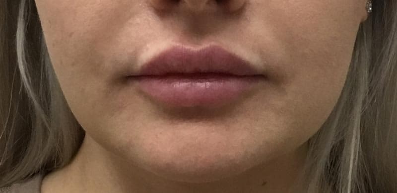 lip filler after