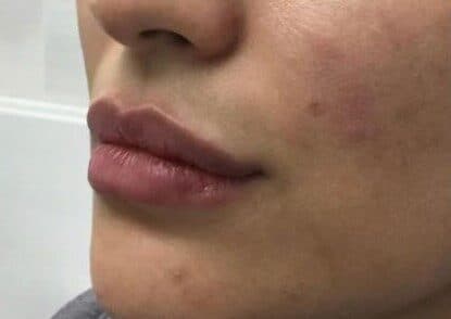 lip filler after