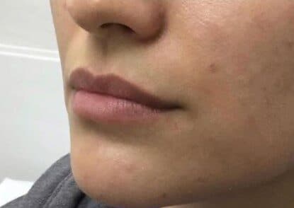 lip filler before