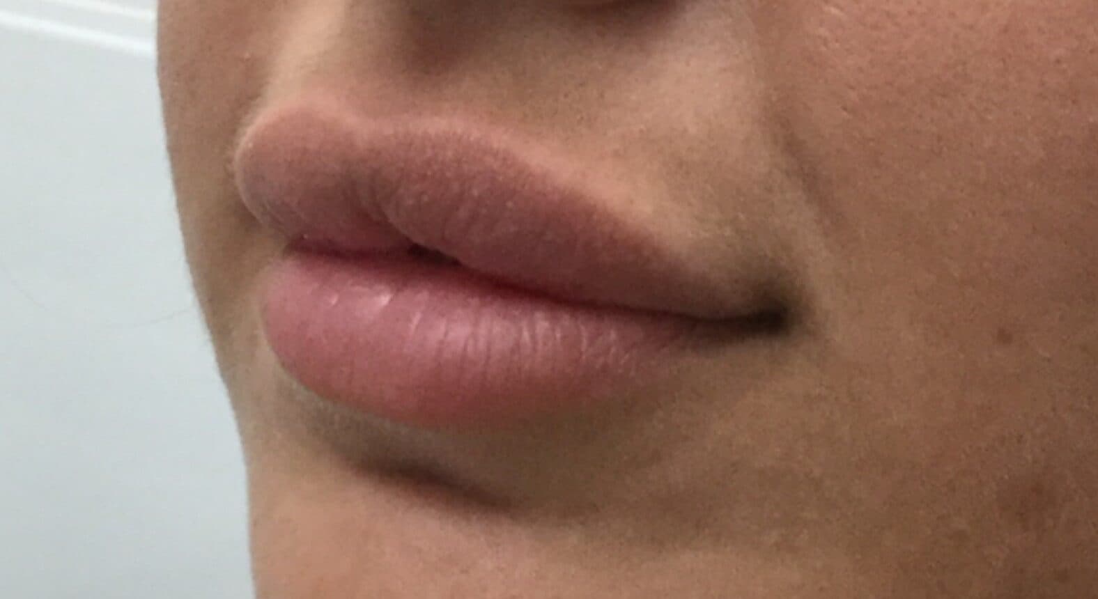 lip filler after