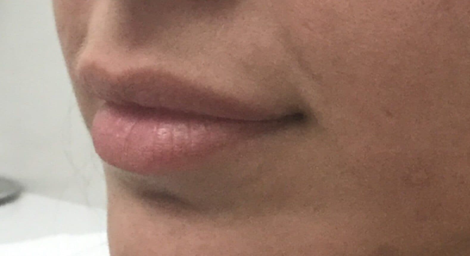 lip filler before