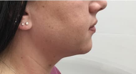 liposuction after