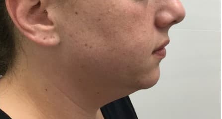 liposuction before