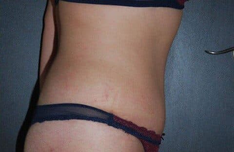 liposuction after
