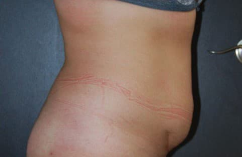 liposuction before