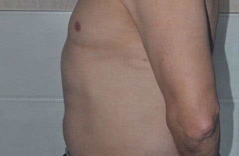 liposuction after