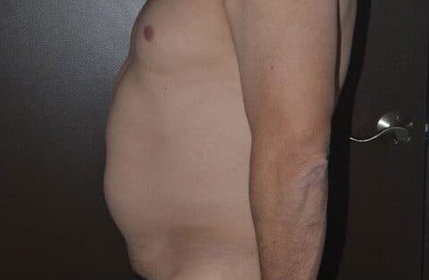 liposuction before