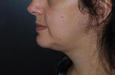 liposuction after
