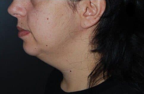 liposuction before