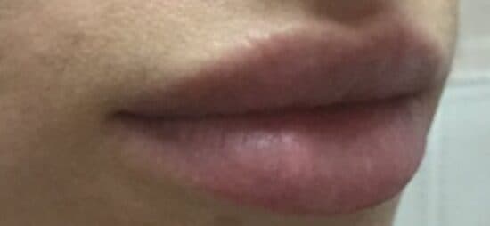 lip filler after
