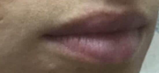 lip filler before