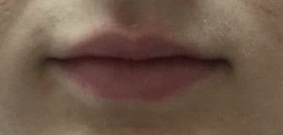 lip filler after