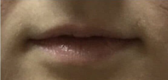 lip filler before