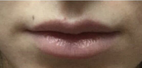 lip filler before