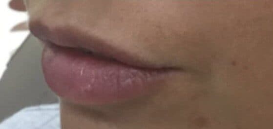 lip filler after