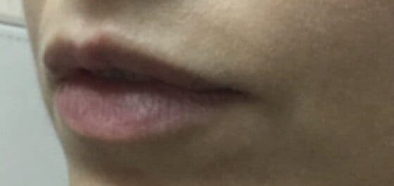 lip filler before