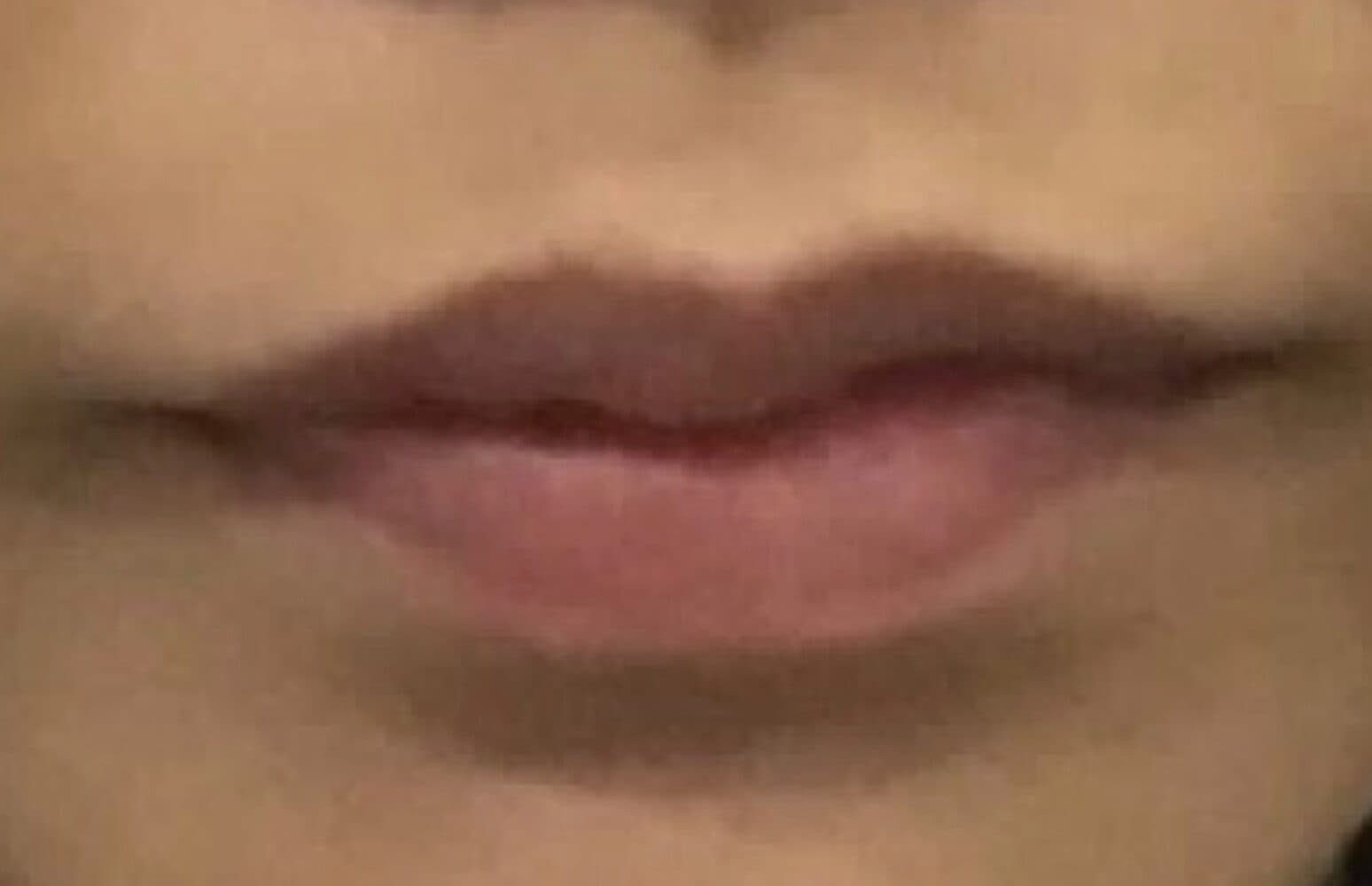 lip filler before