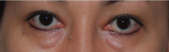 lower eyelid before
