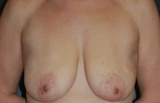 mastopexy before