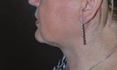 neck lift after